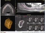 i-CAT_Vision_Mandible_Sample_low